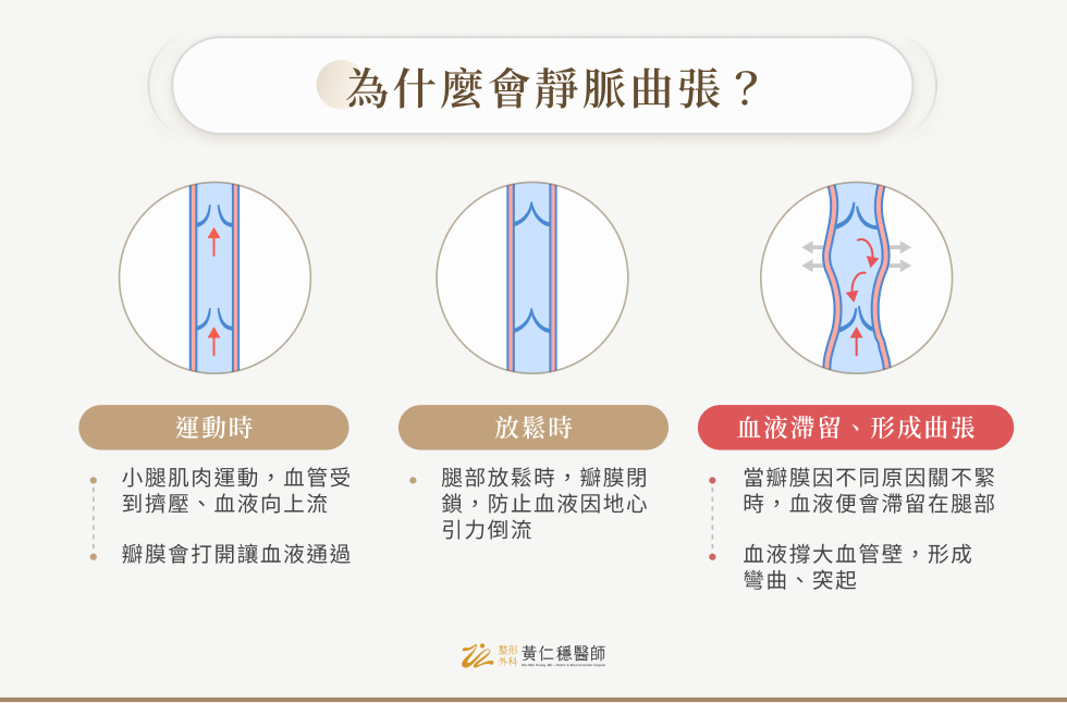 為什為會靜脈曲張？