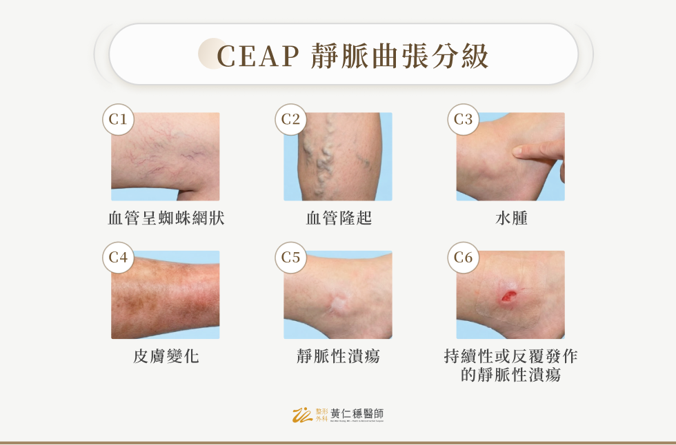 CEAP 靜脈曲張分級