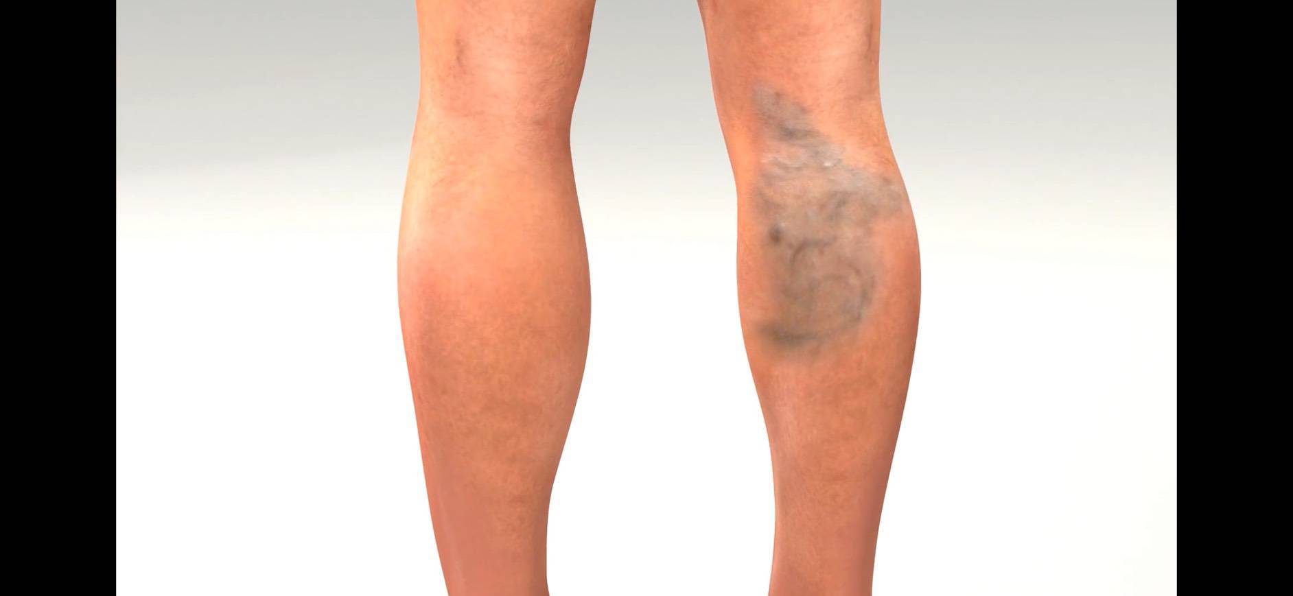 靜脈膠水治療前