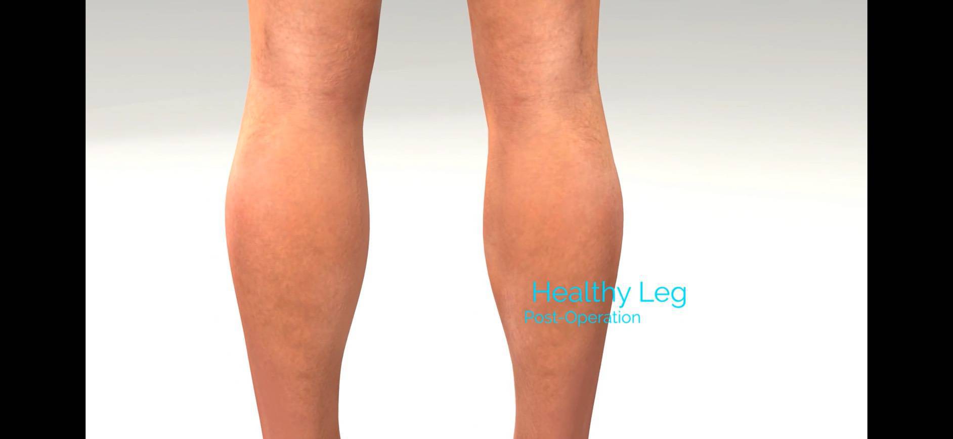 靜脈膠水治療後