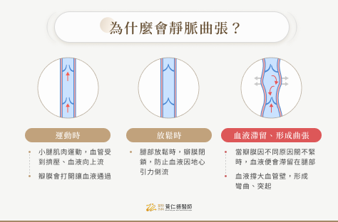 為什麼會靜脈曲張?