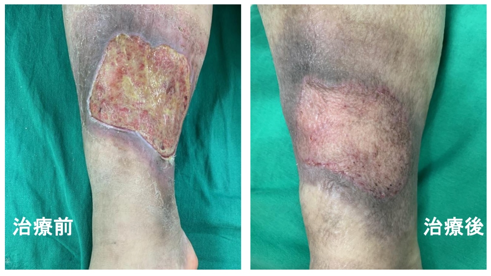 靜脈曲張治療前後