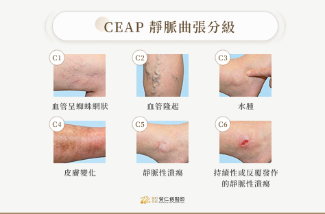 CEAP 靜脈曲張分級