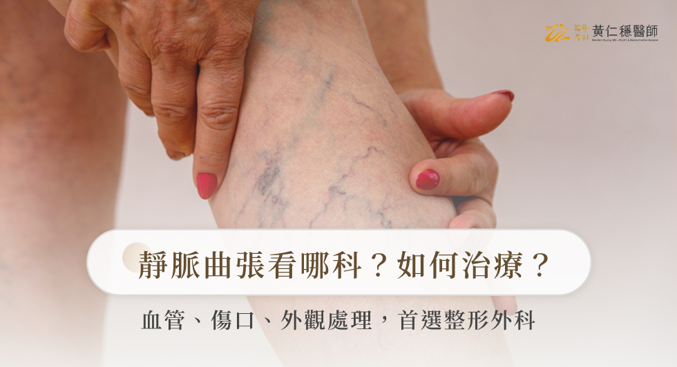 靜脈曲張看哪科？如何治療？血管、傷口、外觀處理，首選整形外科