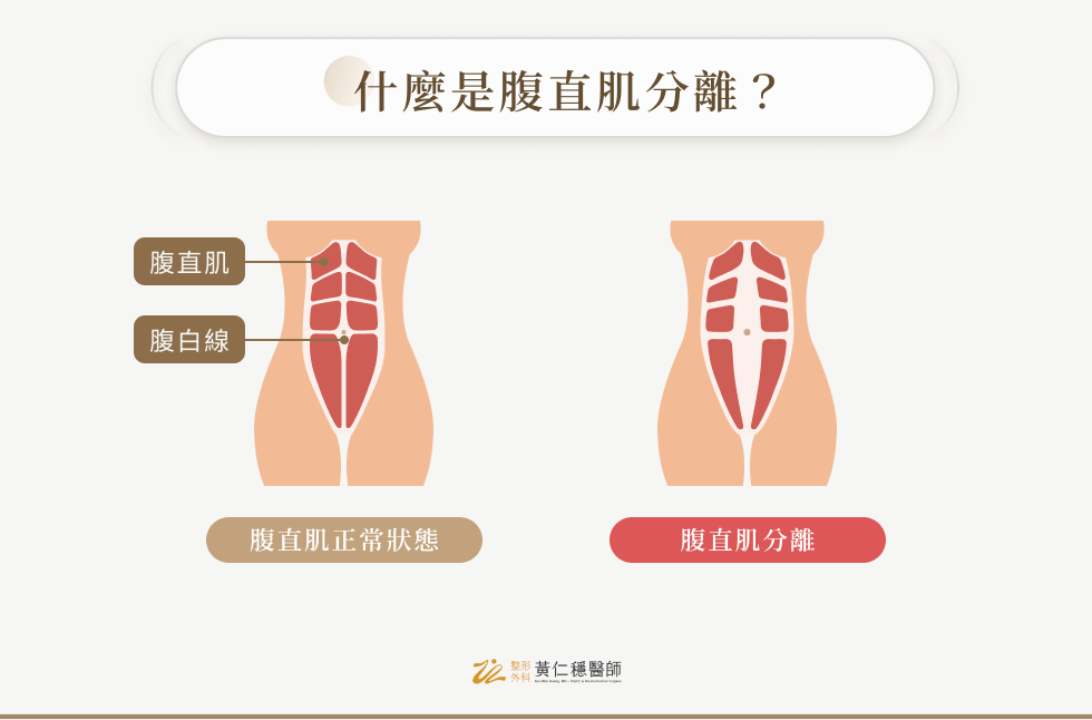 什麼是腹直肌分離？