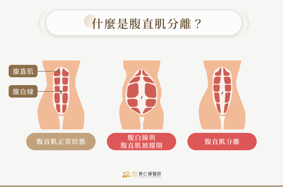 什麼是腹直肌分離？