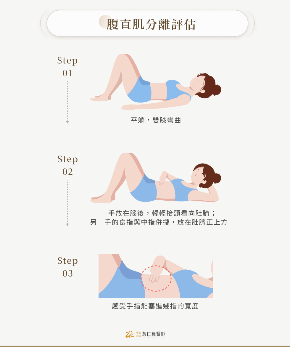 腹直肌分離評估