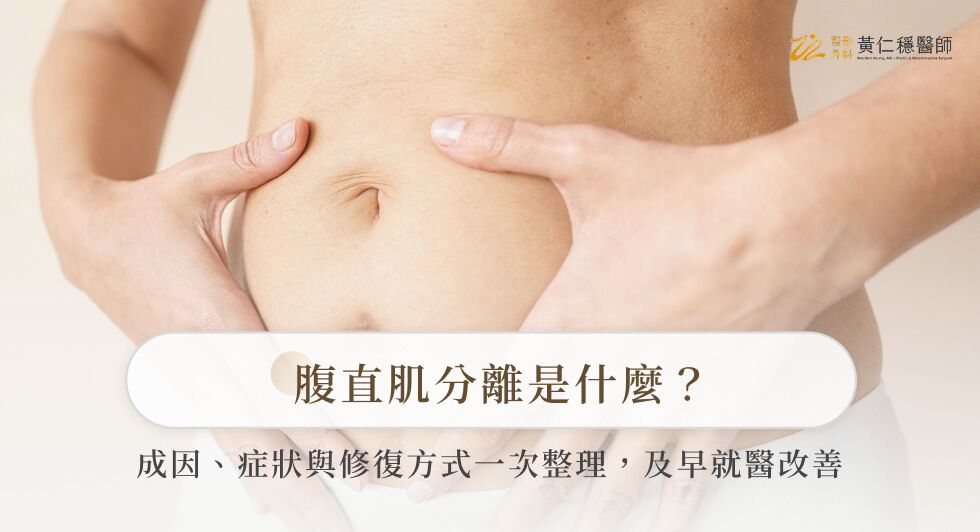 腹直肌分離是什麼？成因、症狀與修復方式一次整理，及早就醫改善