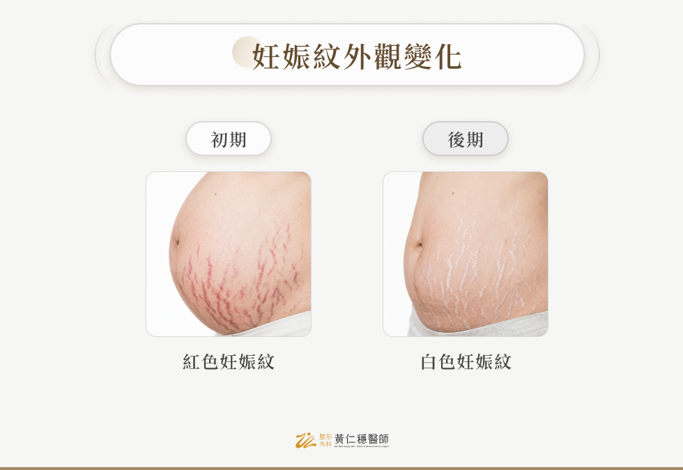 妊娠紋外觀變化