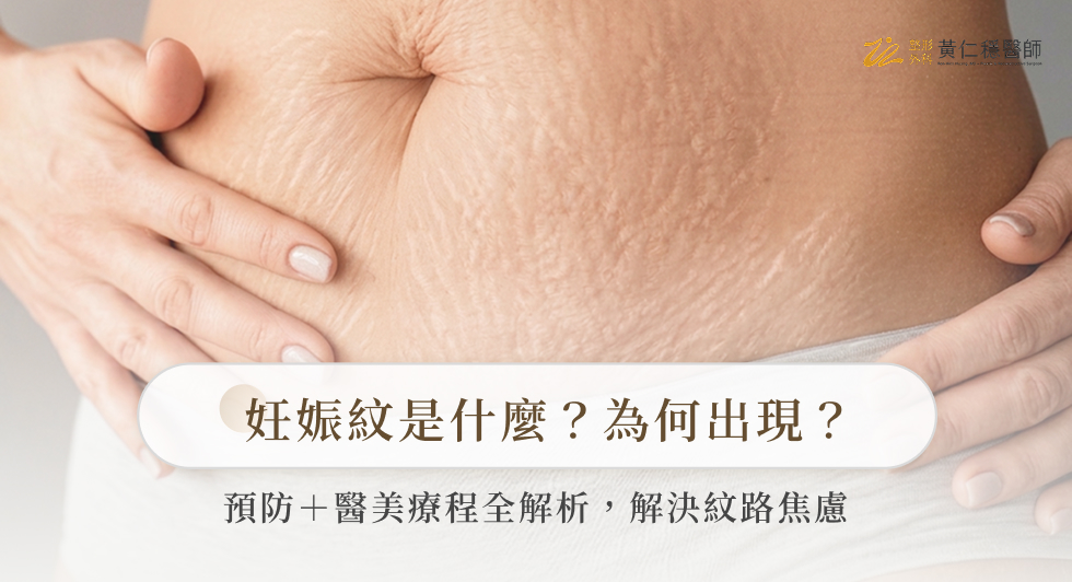 妊娠紋是什麼？為何出現？預防＋醫美療程全解析，解決紋路焦慮
